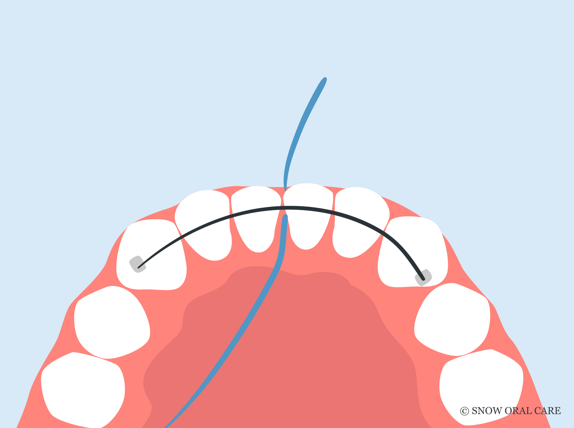 how to floss under permanent retainer without threader