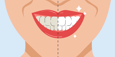 how to remove stains from bonded teeth at home 