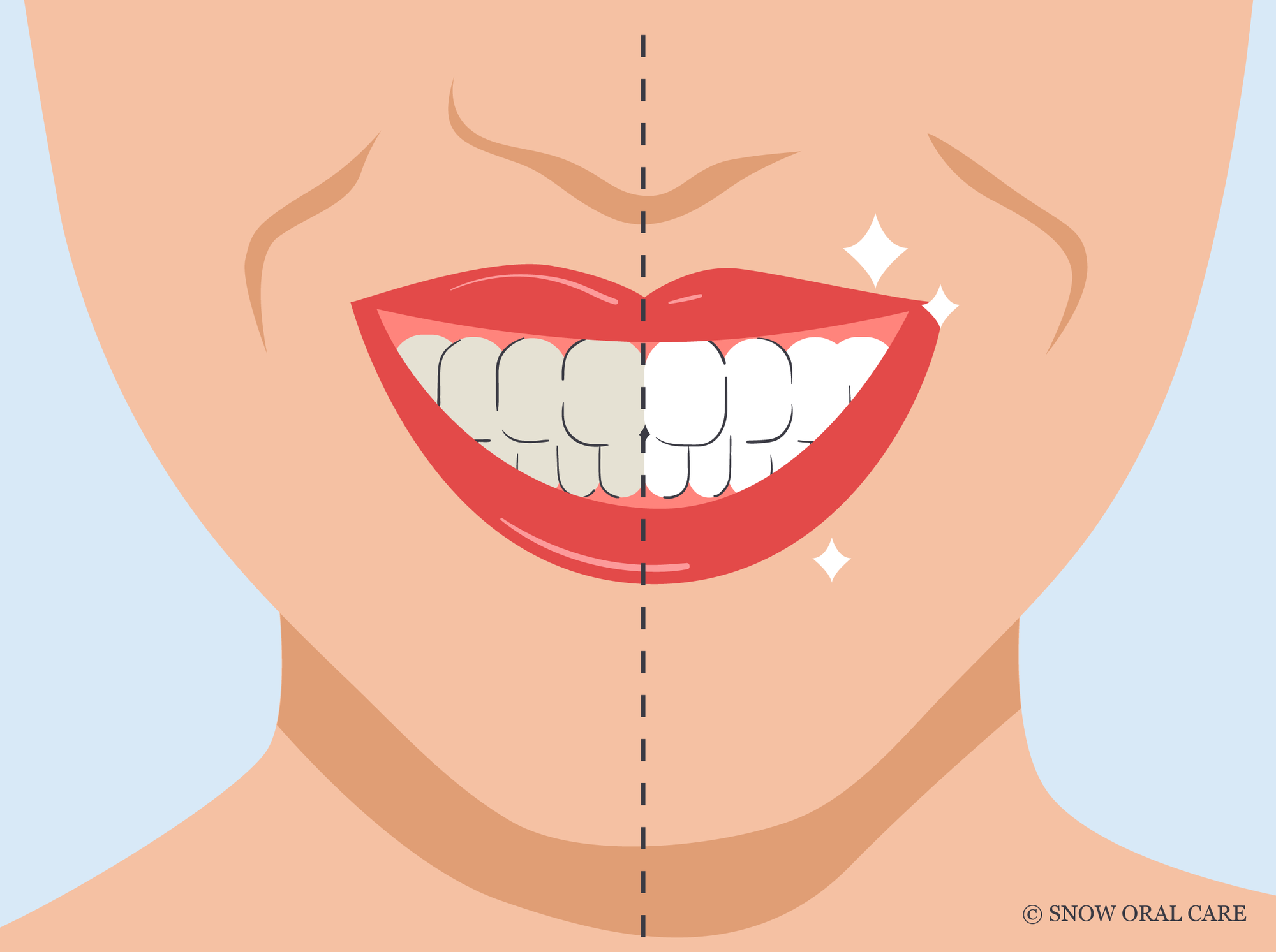 how to remove stains from bonded teeth at home 