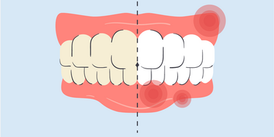 how to treat burned gums from teeth whitening 