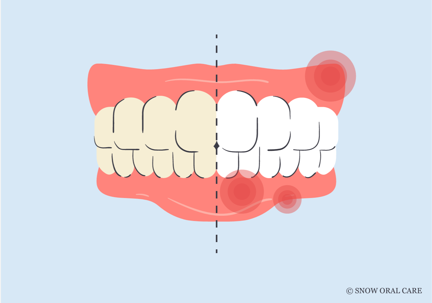 how to treat burned gums from teeth whitening 