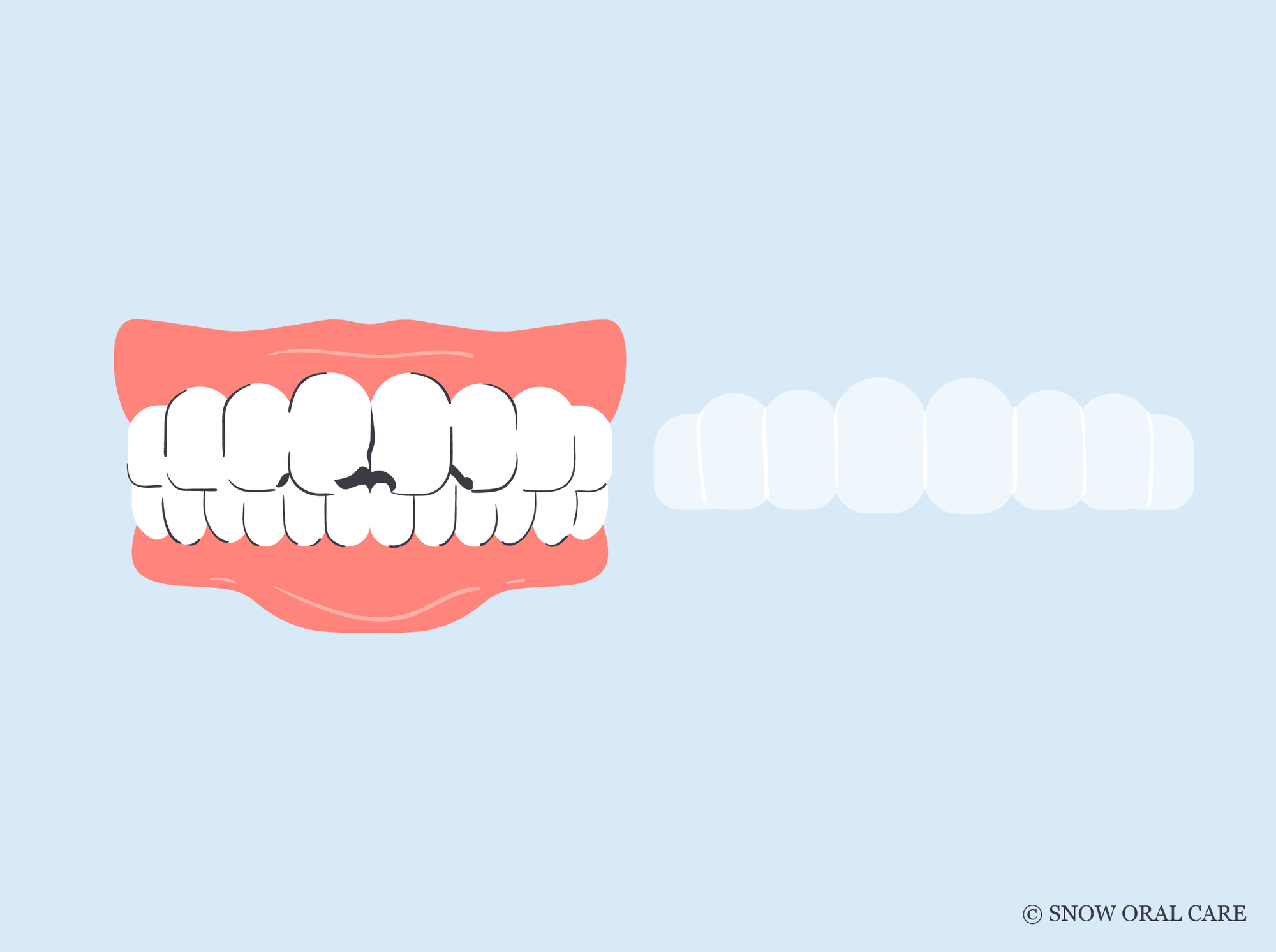 how to whiten bonded teeth 