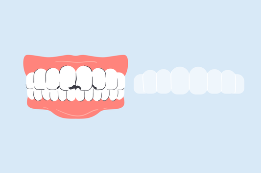 how to whiten bonded teeth 