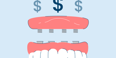 Hybrid Denture Cost, Pros, and Cons