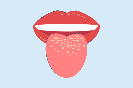 How to Prevent Oral Thrush (Oral Candidiasis)