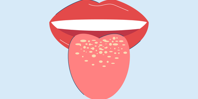 How to Prevent Oral Thrush (Oral Candidiasis)
