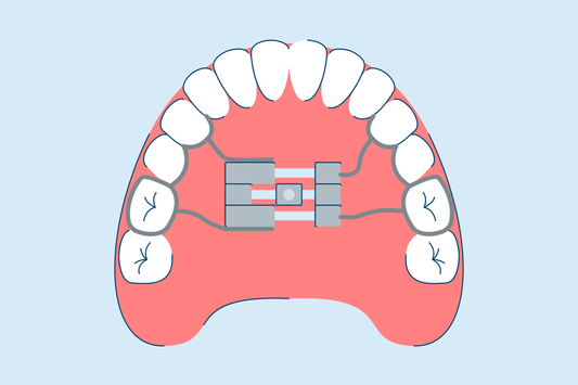 Palate Expanders: Types, Uses, Adjusting, and Care