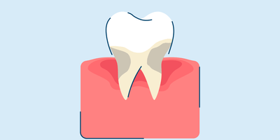 Periodontitis: Symptoms, Causes, and Treatments