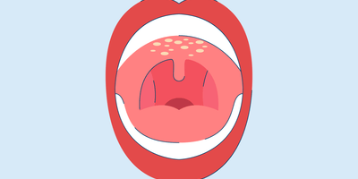 Roof of Mouth Hurts? Here's What May Be Causing it and Treatments.