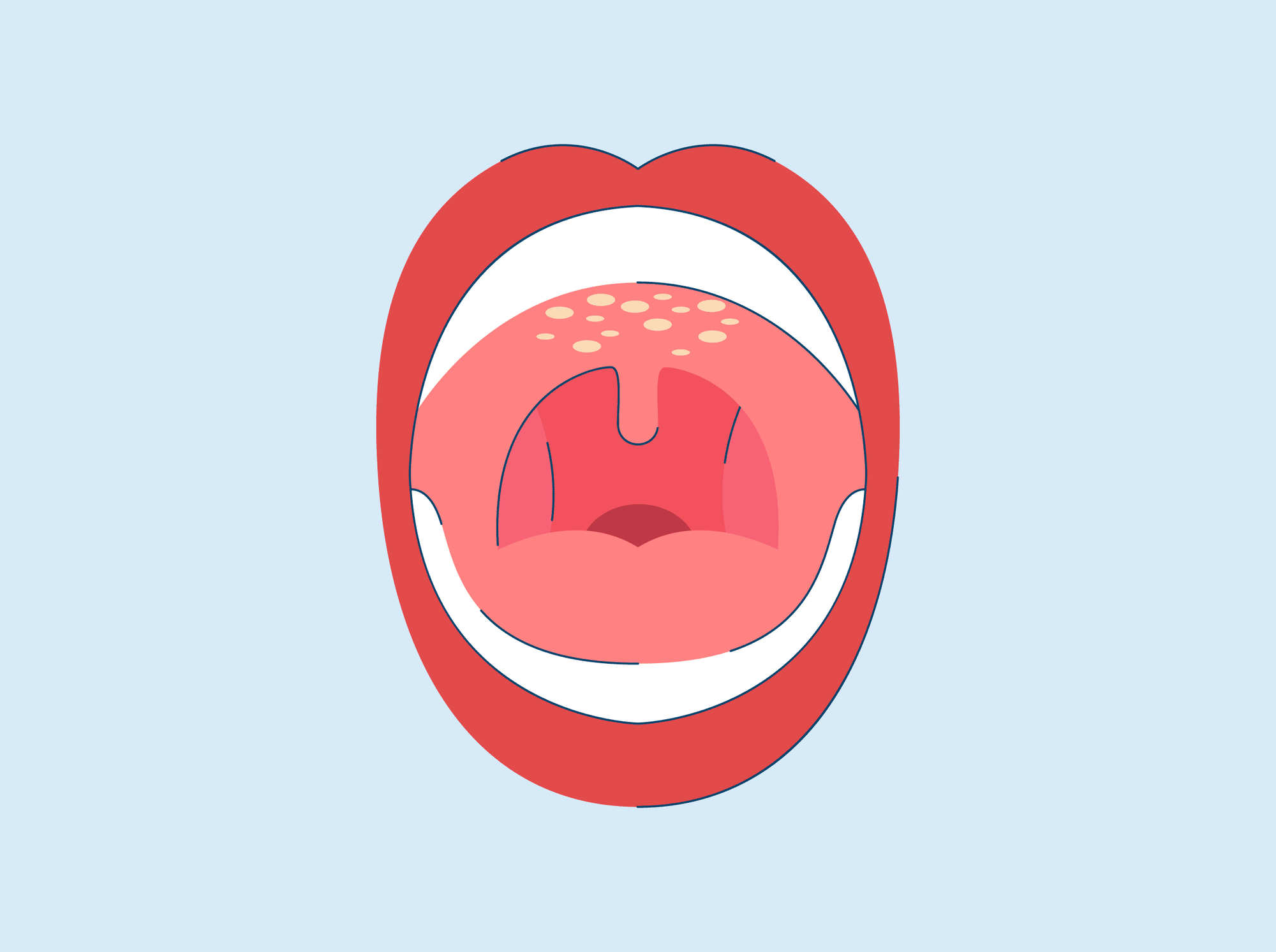 Roof of Mouth Hurts? Here's What May Be Causing it and Treatments.