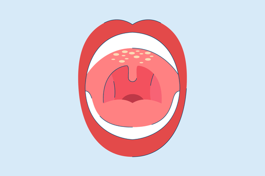 Roof of Mouth Hurts? Here's What May Be Causing it and Treatments.