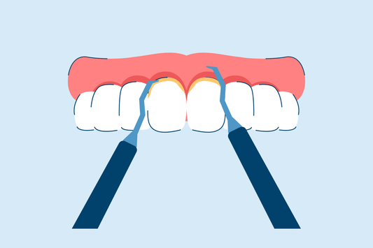 Scaling and Root Planing for Gum Disease