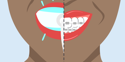 should i whiten my teeth before braces 