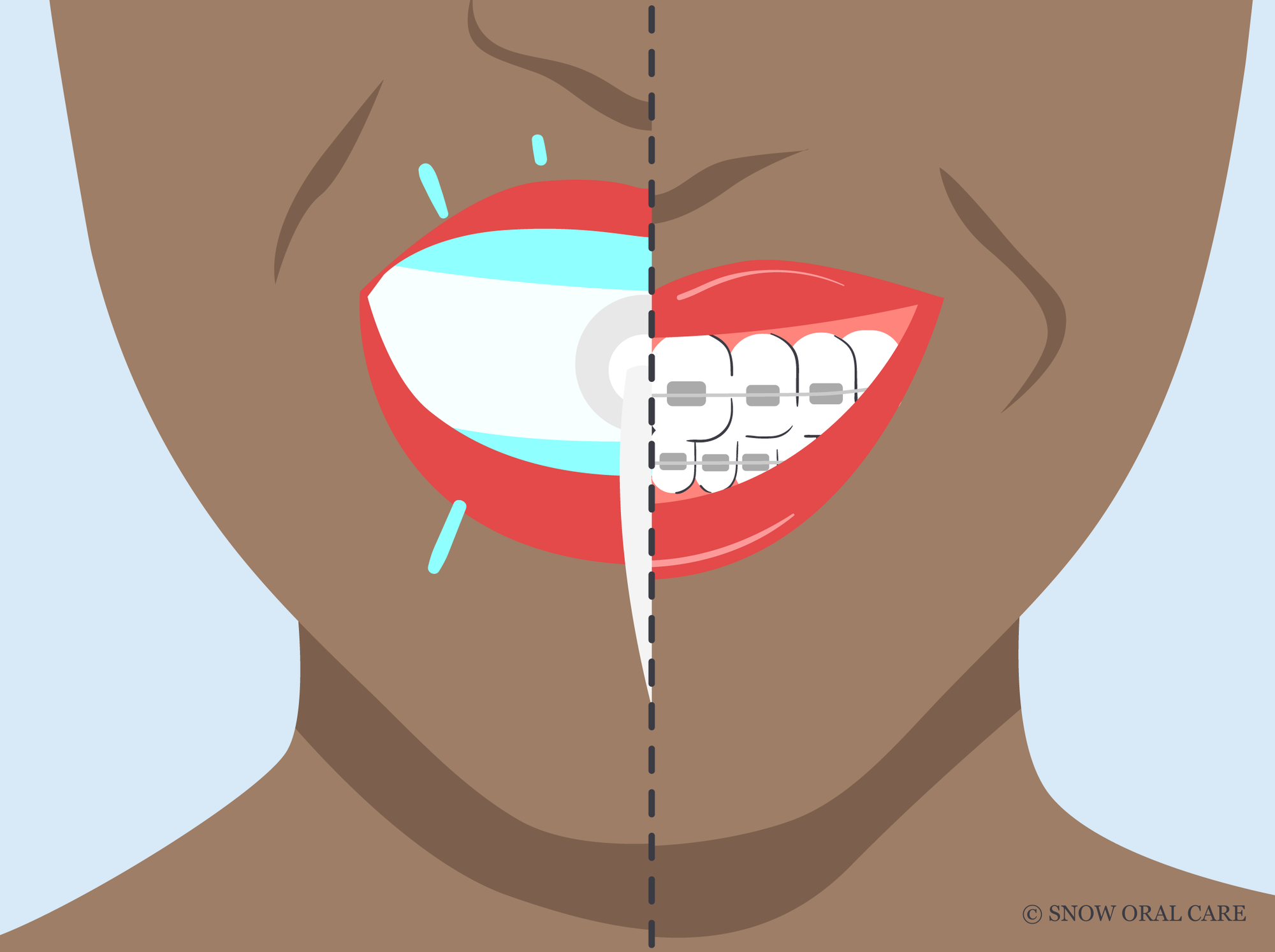 should i whiten my teeth before braces 