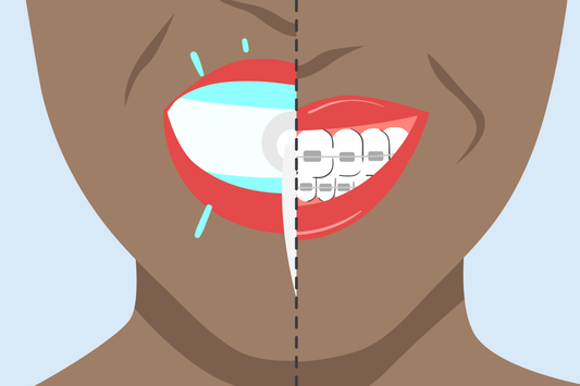 should i whiten my teeth before braces 