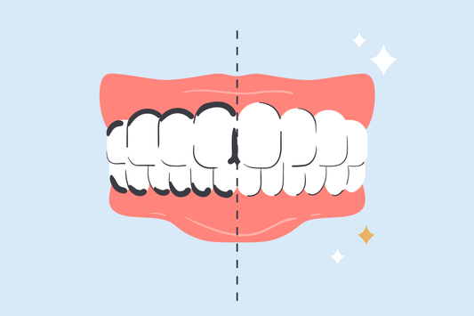 silver diamine fluoride stain removal from teeth 