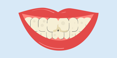 stained fillings front teeth