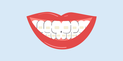 stained teeth after braces 