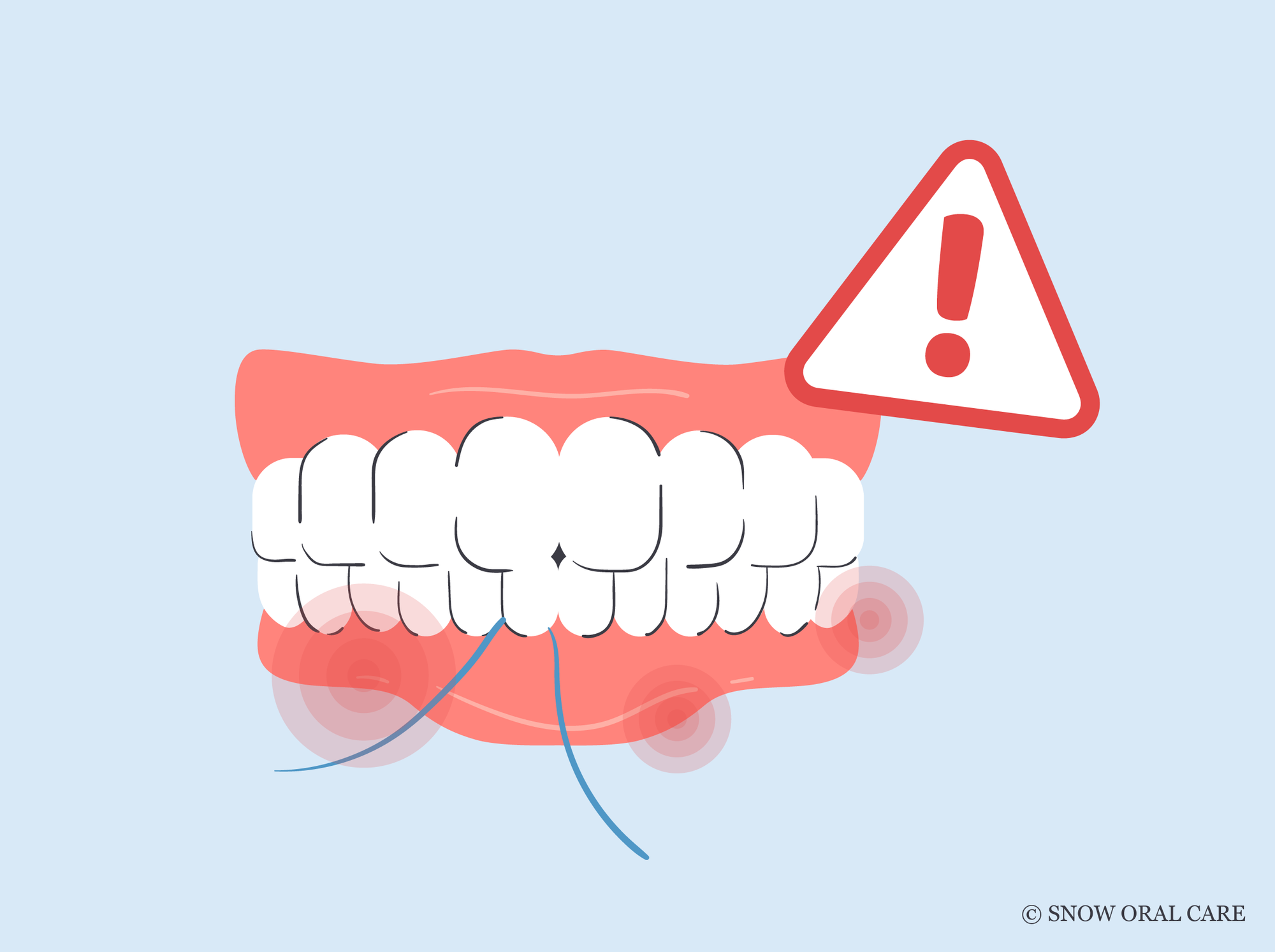 teeth hurt after flossing