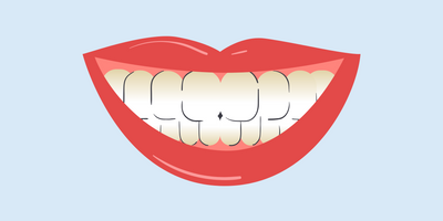 teeth not whitening near gums 