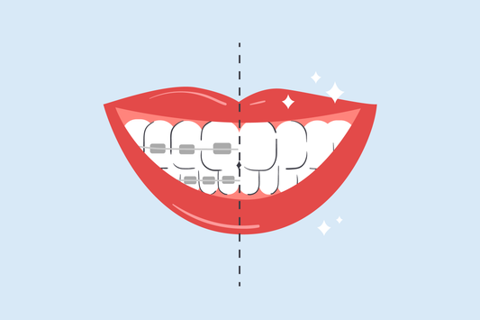 teeth whitening after braces 