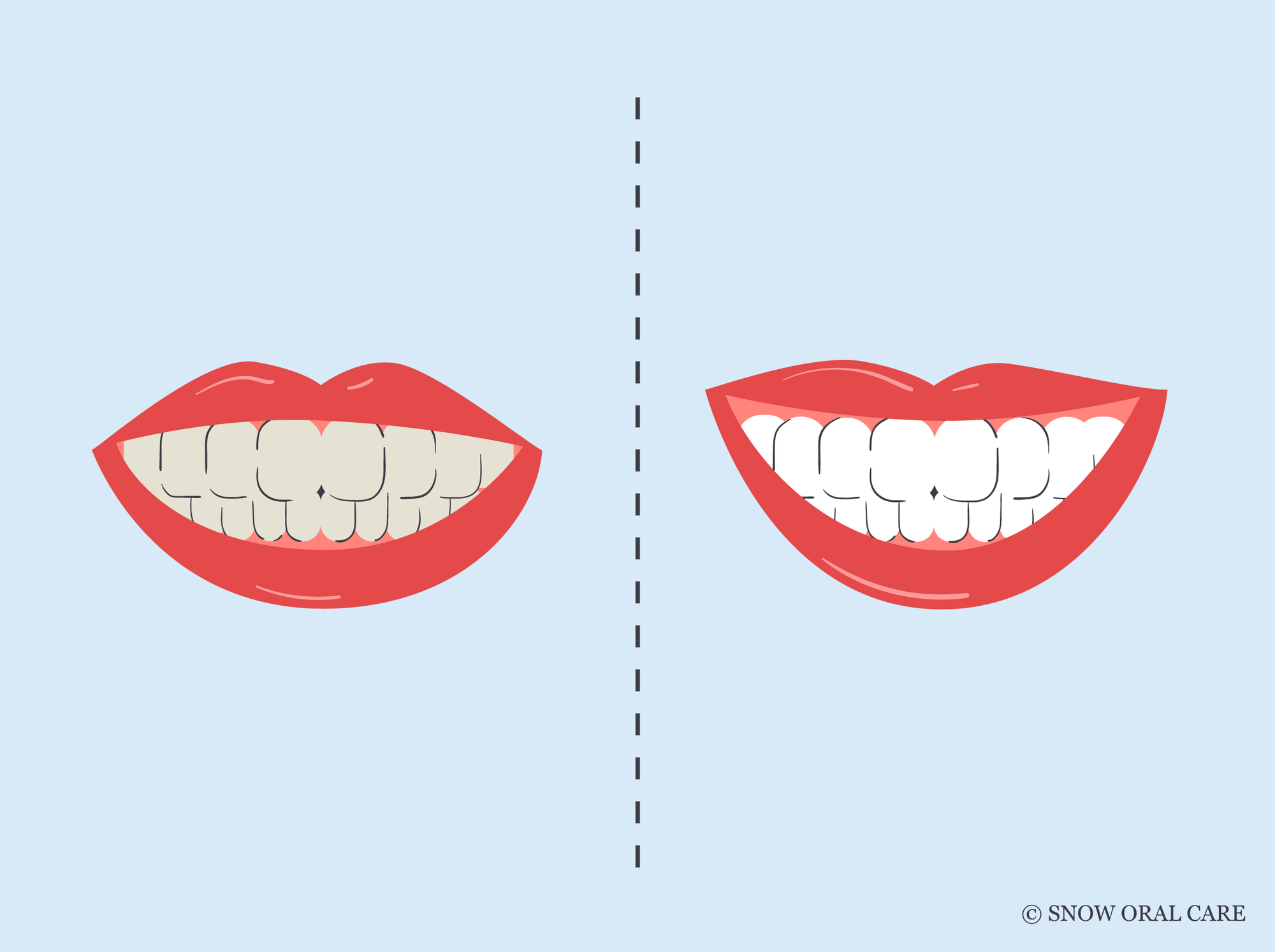 teeth whitening before and after