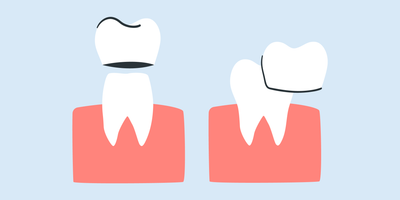 teeth whitening for crowns and veneers 