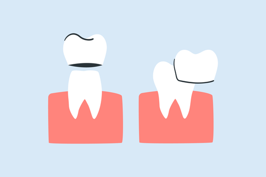 teeth whitening for crowns and veneers 