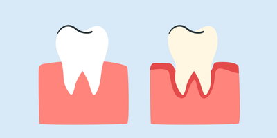 teeth whitening for periodontal disease 