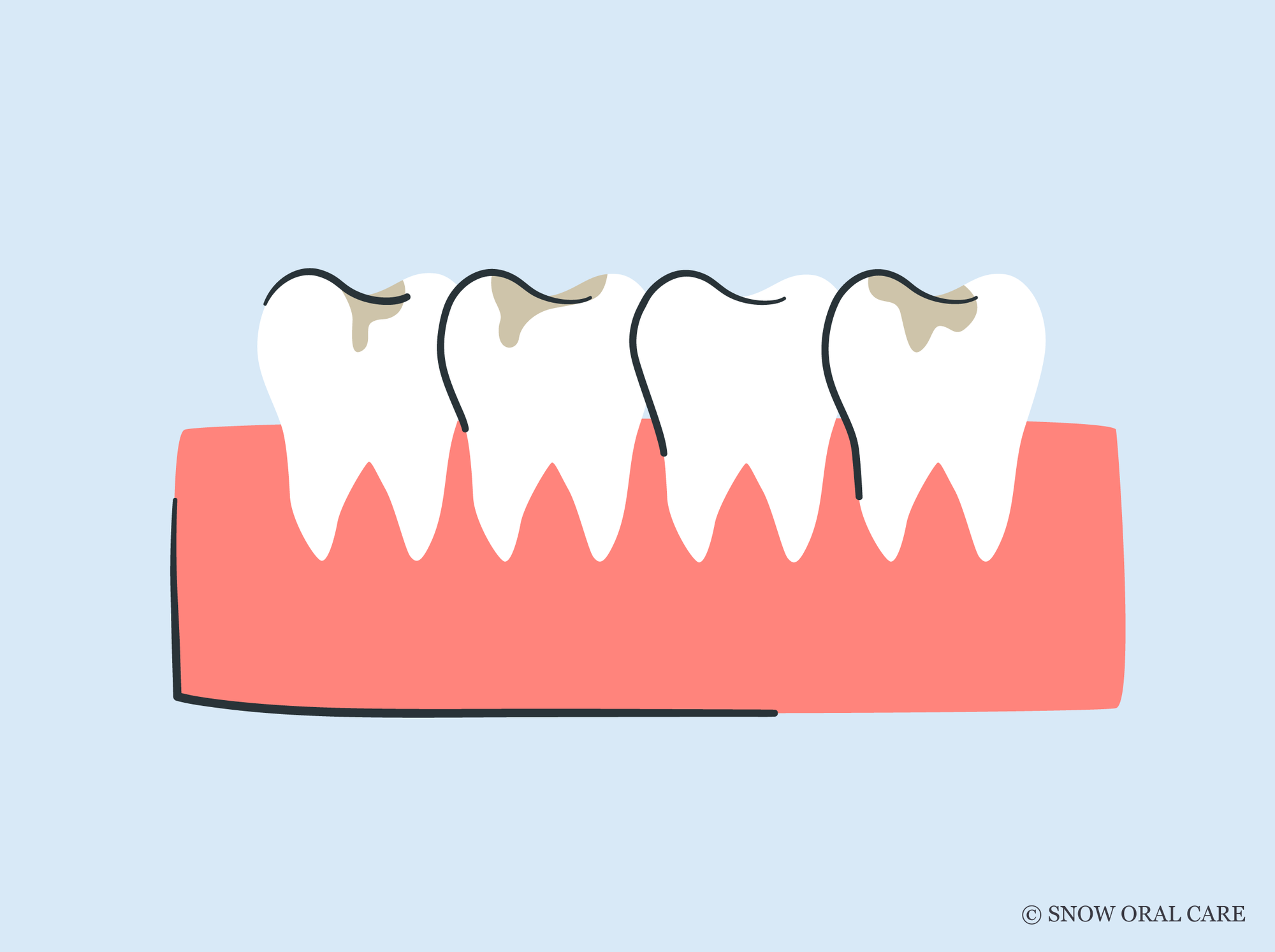 teeth whitening with cavities 