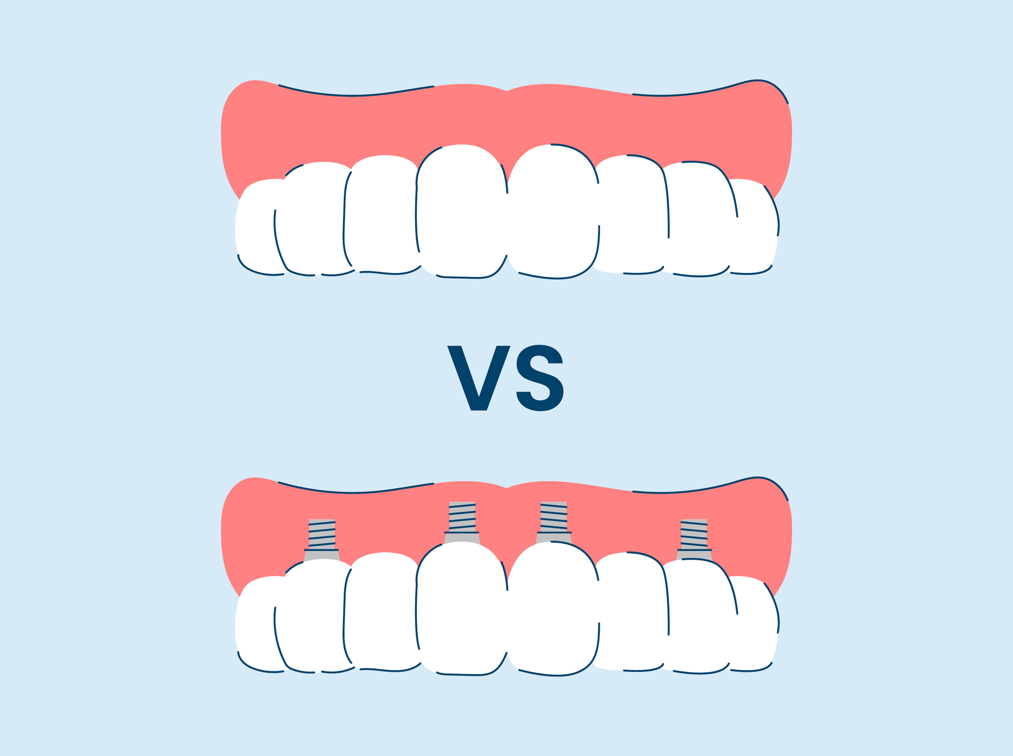 implant supported dentures
