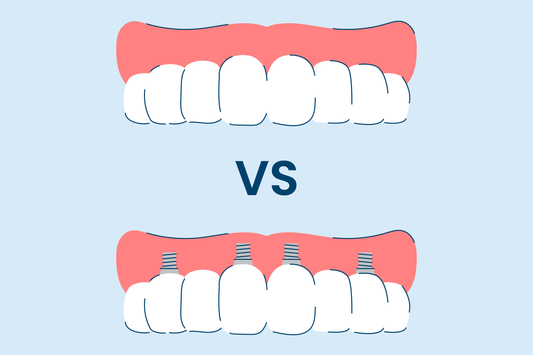 implant supported dentures