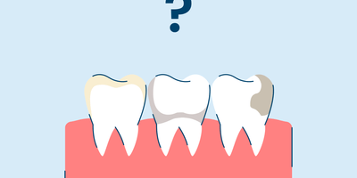 types of teeth stains