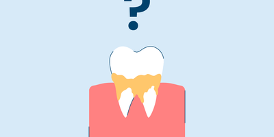 Calcium Deposits on Teeth: Everything You Need To Know [Updated 2026]