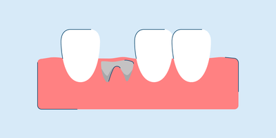 What Does a Dry Socket Look Like?