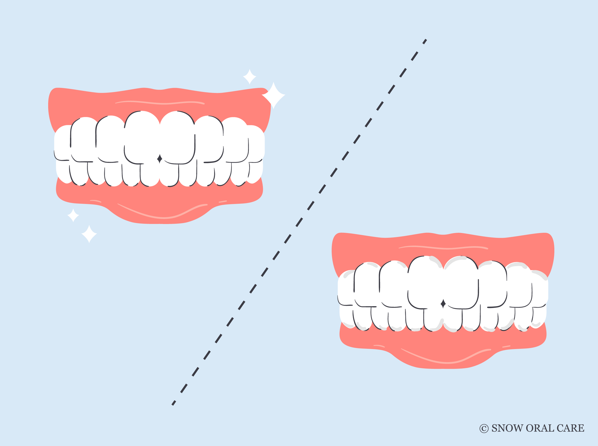 what happens if you don't floss