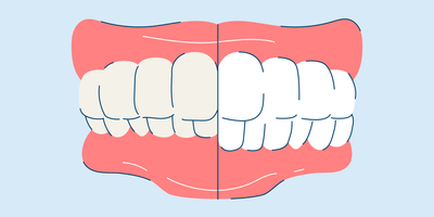 What Is An Overbite and How Can Overbite Teeth Be Fixed?