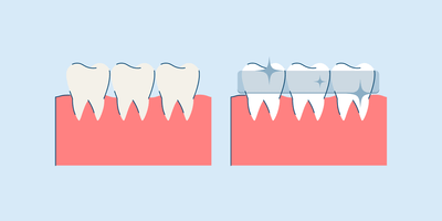 what is teeth whitening