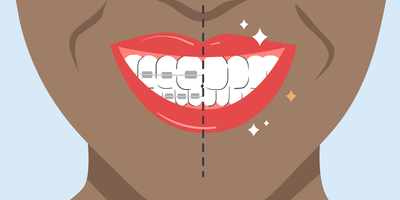 white spots on teeth after braces 