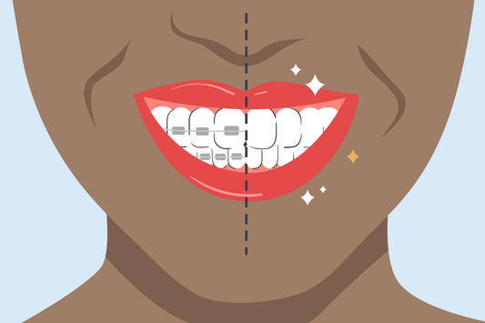 white spots on teeth after braces 