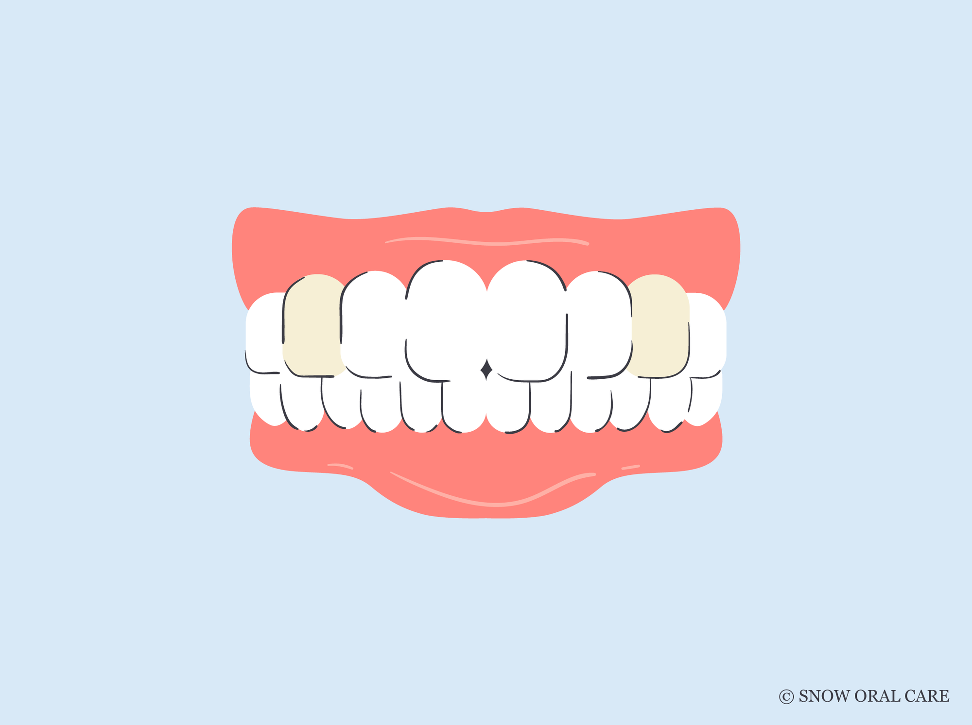why are my canine teeth yellow 