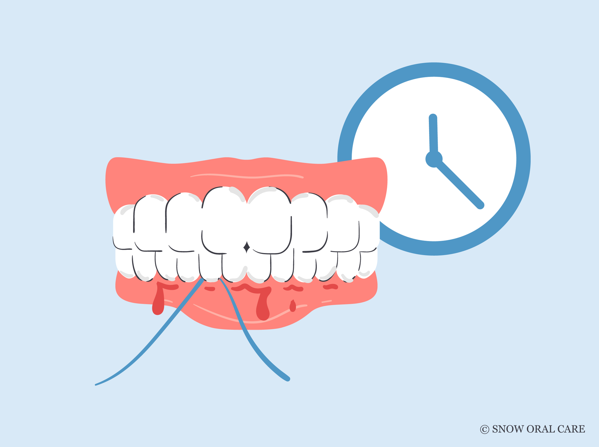 why do gums bleed after not flossing for a while