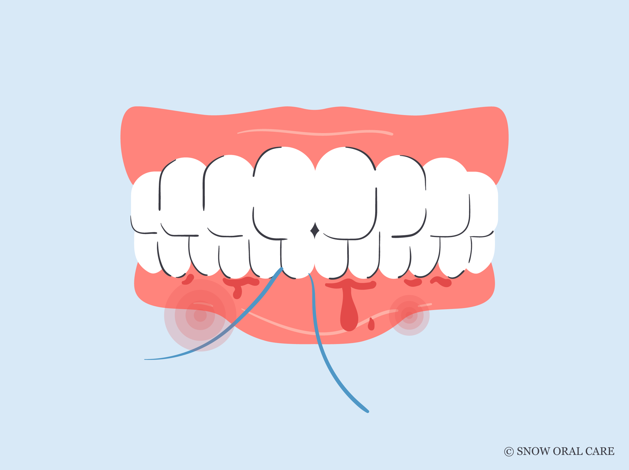 why do my gums bleed when i floss