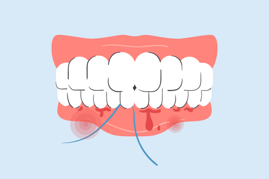 why do my gums bleed when i floss