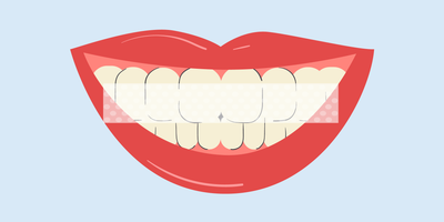 why don't whitening strips cover all teeth 