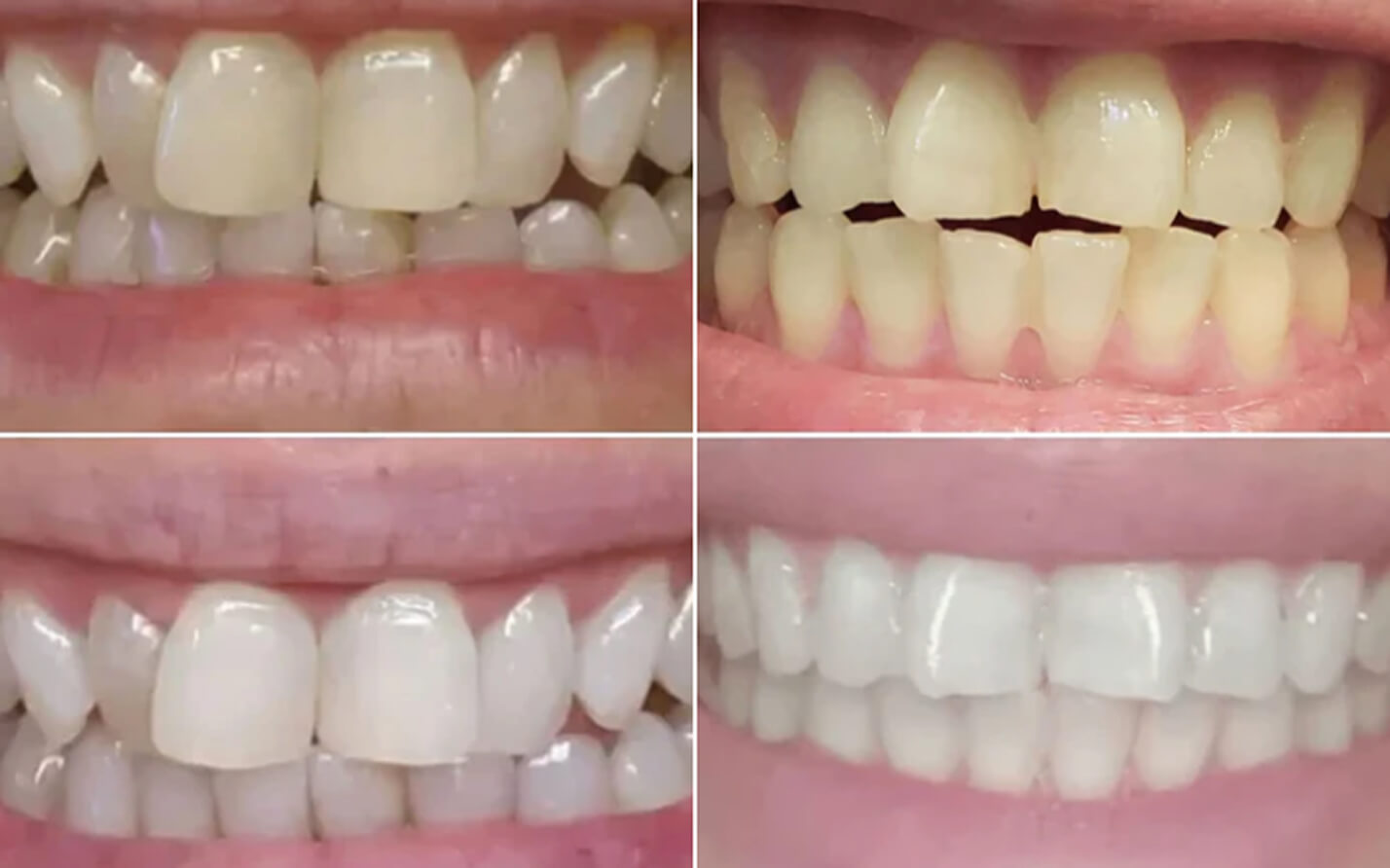 Close-up before and after shots of brighter teeth