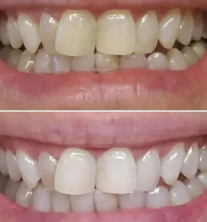 Before and after close-up of a customer&rsquo;s smile