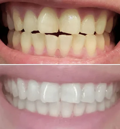 Before and after close-up of a customer&rsquo;s smile