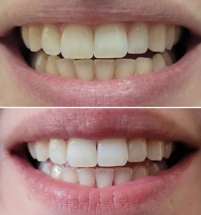 Before and after close-up of a customer&rsquo;s smile
