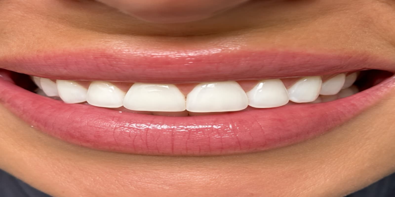 Teeth after